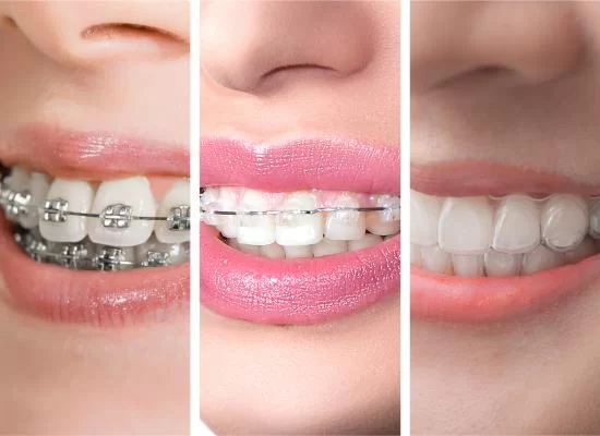 Braces, Aligners, and Ceramic Braces