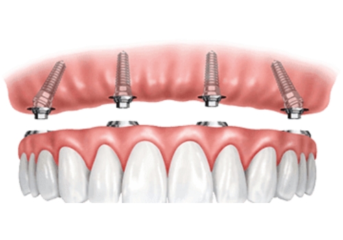 Root Canal Treatment