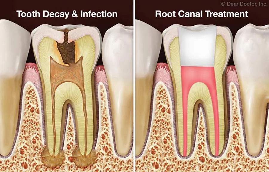 Immediate Loading Basal Implants